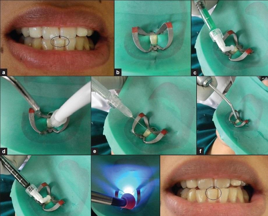 Лечение кариеса ICON Томск Чудесный Удаление зубов под наркозом Томск Челюскинцев