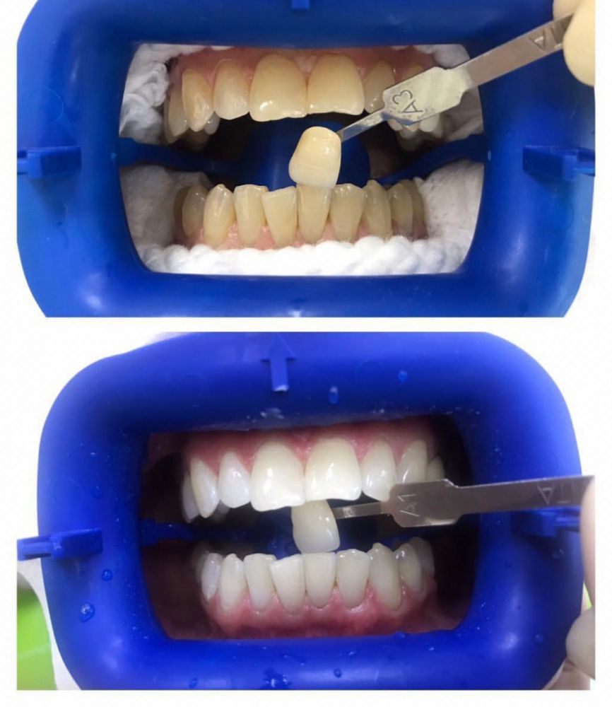 Профессиональное отбеливание зубов система zoom 4 ирригатор 462 waterpik отзывы