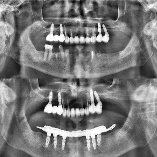 ¿Tienes dentaduras extraíbles y tienes miedo de que se caigan en el momento equivocado? фото 3