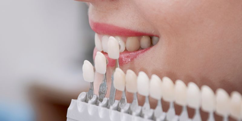 Tipos de blanqueamiento dental-pros y contras фото 1