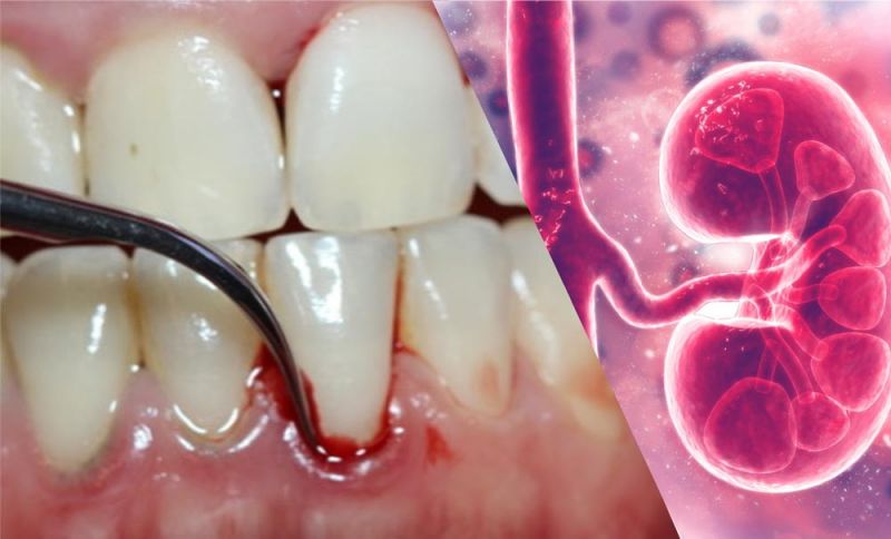 Periodontitis and chronic renal failure фото 1
