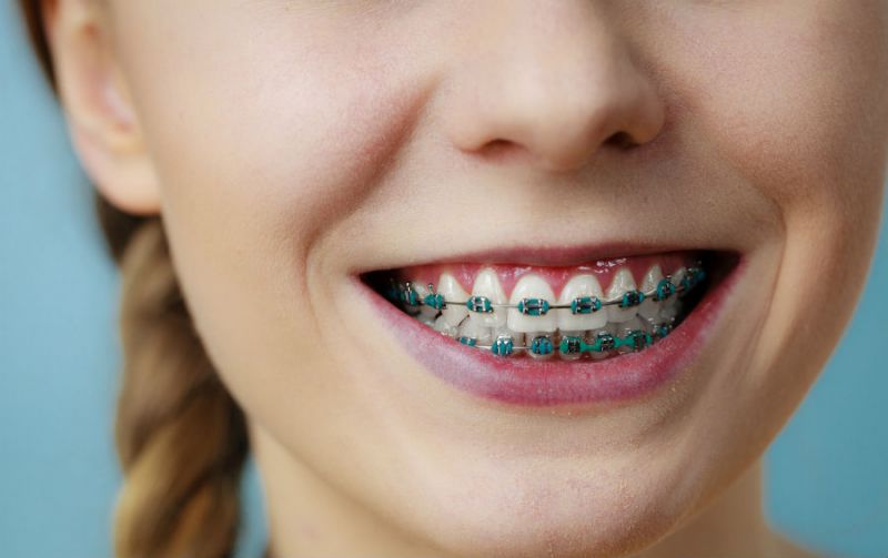 Malocclusion in adults – when should I put braces? фото 1