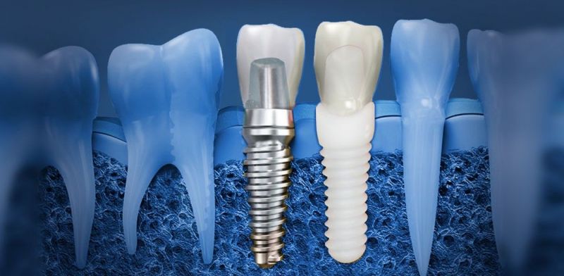 The most interesting dental implants фото 1