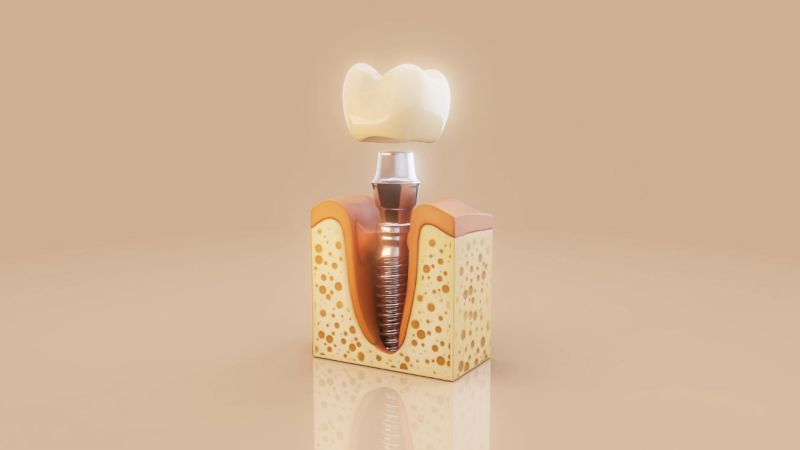 The most interesting dental implants фото 1