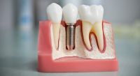 Implantación, prótesis y tratamiento de ortodoncia para diabetes mellitus.