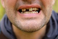 Dientes malos: ¿qué hacer?